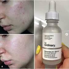The Ordinary Niacinamide 10% + Zinc 1 % (30ML )
